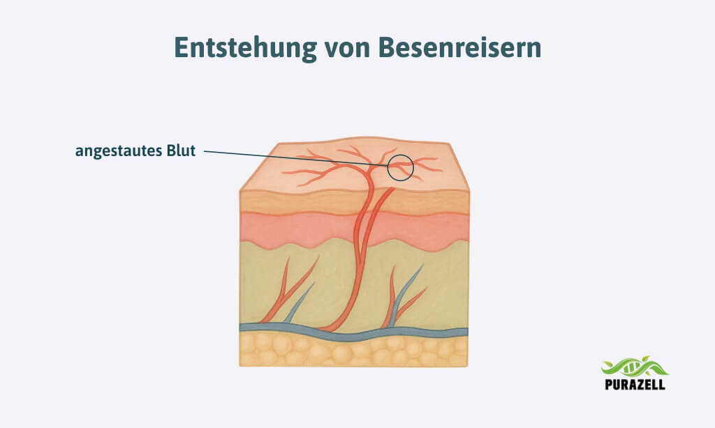 besenreiser-entstehung-haut