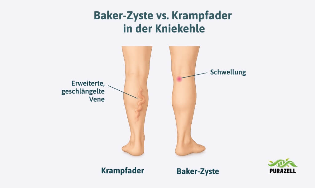 krampfadern-kniekehle-vs-baker-zyste