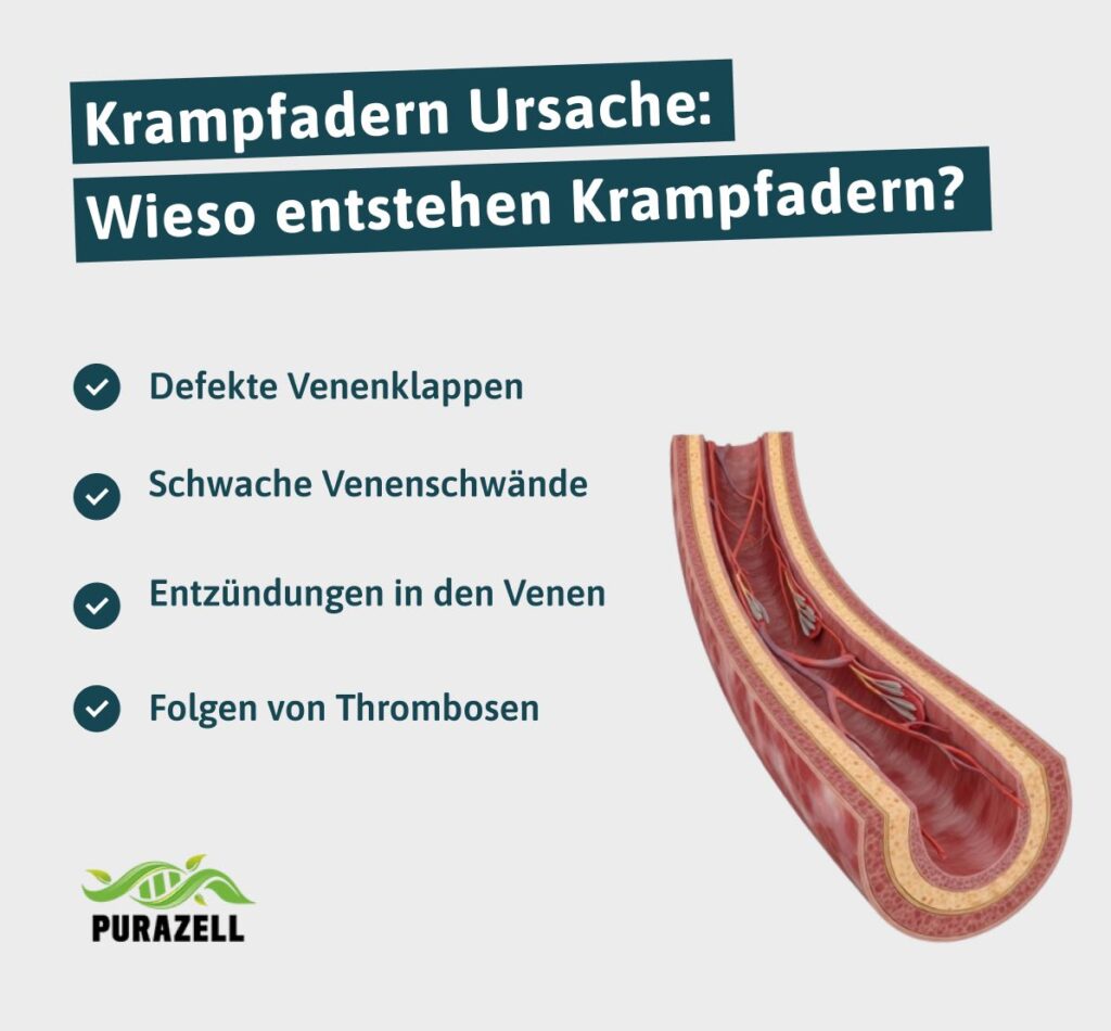 krampfadern-entstehung-gründe