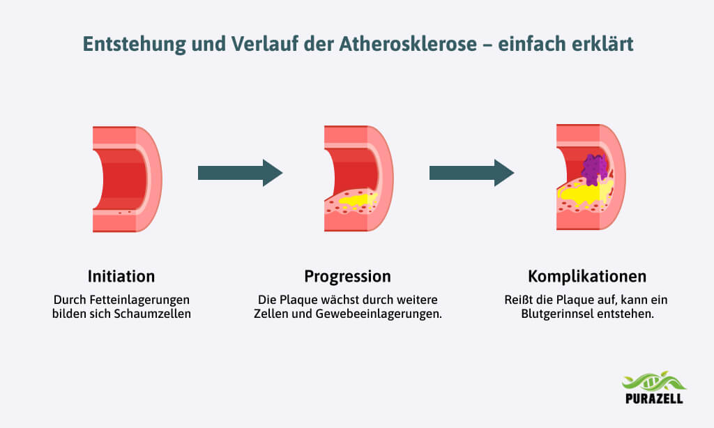 durchblutungsstoerungen-entstehungung-atherosklerose