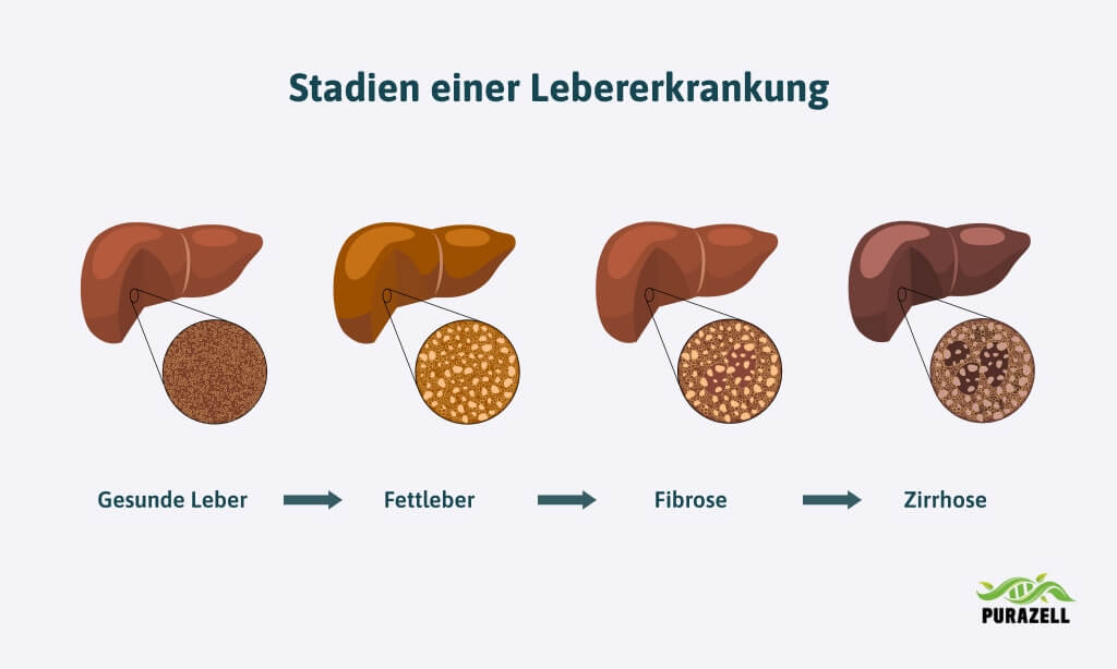 loewenzahn-leber-entgiften-stadien-lebererkrankung