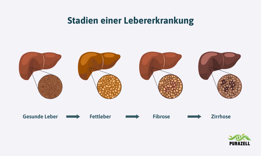 fettleber-stadien-lebererkrankung