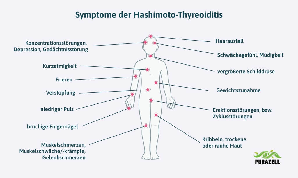 schilddruesenentzuendung-hashimoto-symptome