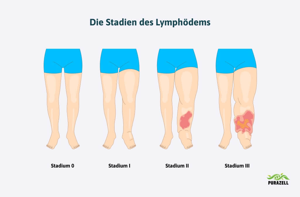wassereinlagerung-schwangerschaft-stadien-lymphoedem