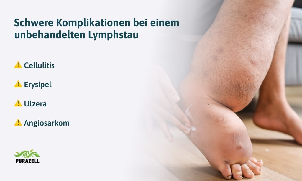 lymphstau-schwere-komplikationen